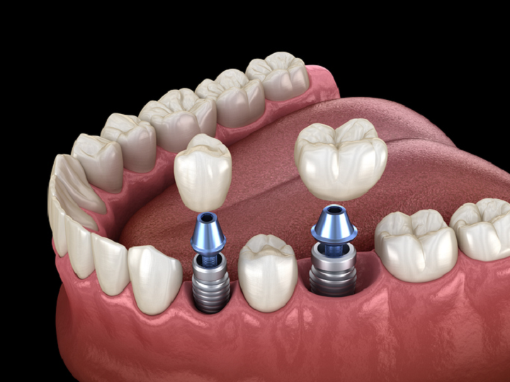 Implantes Dentales: beneficios y cuidados