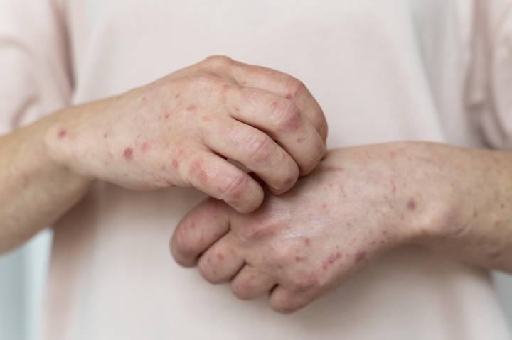 dermatitis-atopica-que-es-y-como-se-manifiesta imagen de artículo