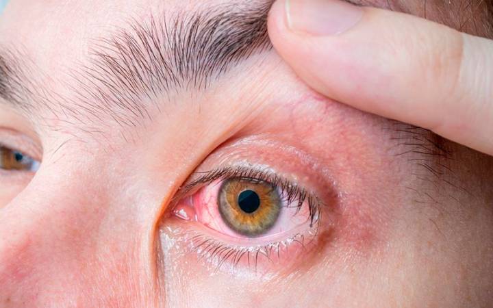 conjuntivitis-alergica-la-importancia-de-tratarla-con-un-oftalmologo imagen de artículo