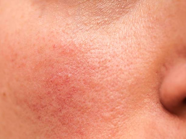 rosacea-conoce-y-maneja-esta-enfermedad-cutanea imagen de artículo