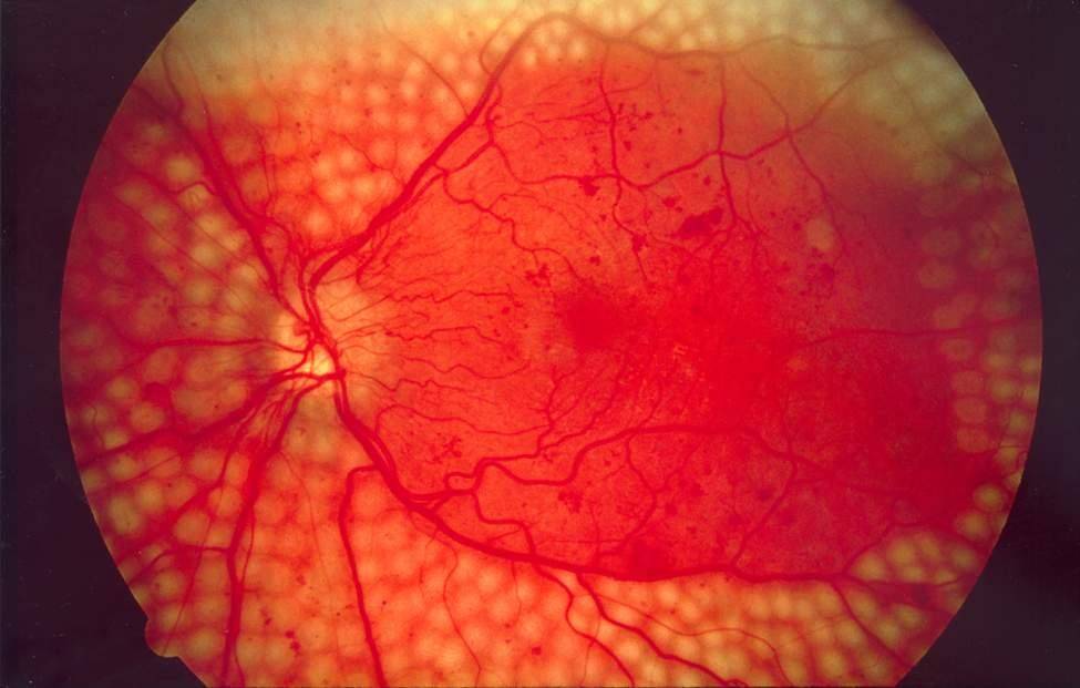 retinopatia-diabetica-una-enfermedad-que-puede-prevenirse imagen de artículo