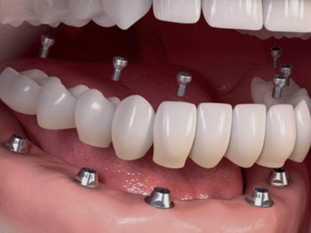 sonrie-de-nuevo-protesis-sobre-implantes-dentales imagen de artículo