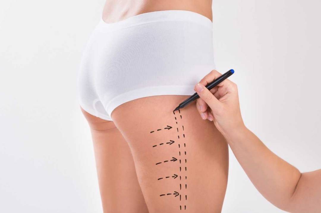 quienes-pueden-realizarse-una-lipoaspiracion imagen de artículo