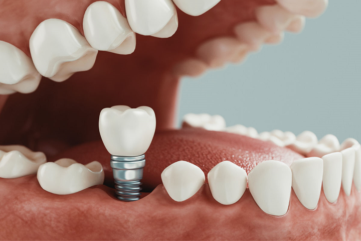 implantes-dentales-una-solucion-con-tecnologia-innovadora imagen de artículo