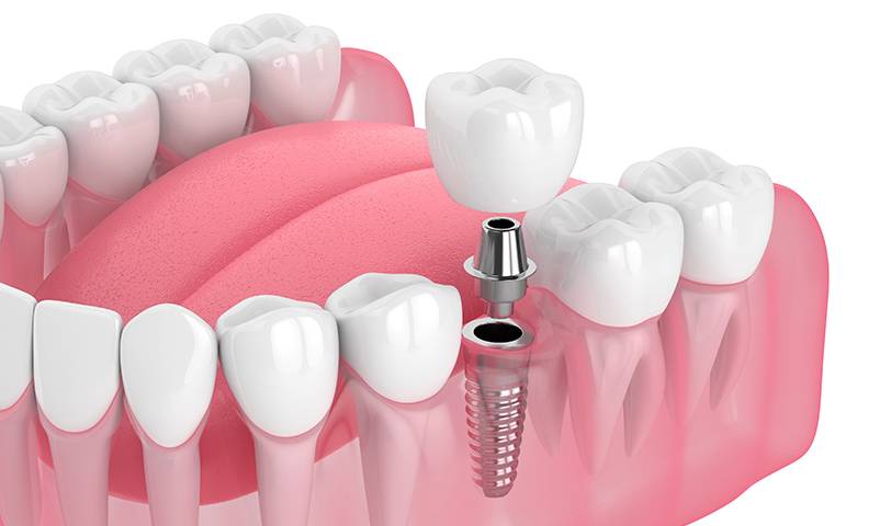 Descubre en qué consiste la colocación de Implantes Dentales