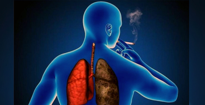 Enfermedades Pulmonares Obstructivas Crónicas: conocer su clasificación es vital