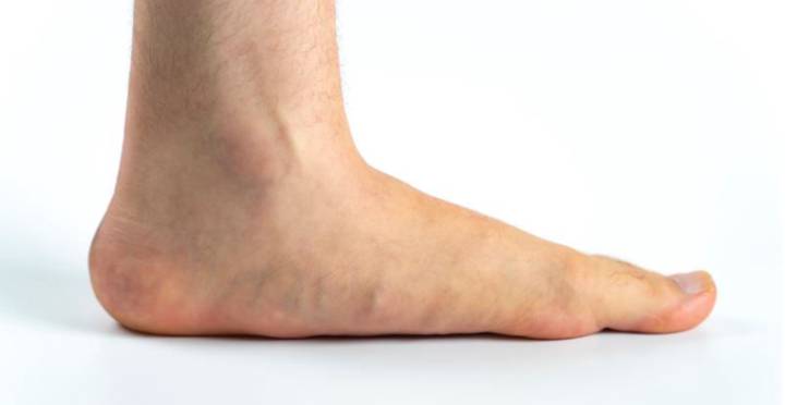 pie-plano-en-ninos-y-adultos imagen de artículo