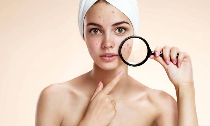 como-enfrentar-el-acne-y-sus-secuelas imagen de artículo