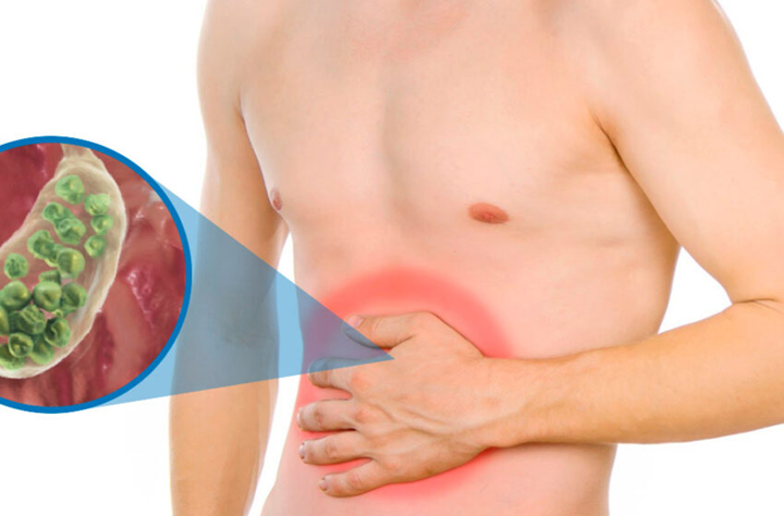 manejo-de-los-sintomas-asociados-a-los-calculos-biliares imagen de artículo