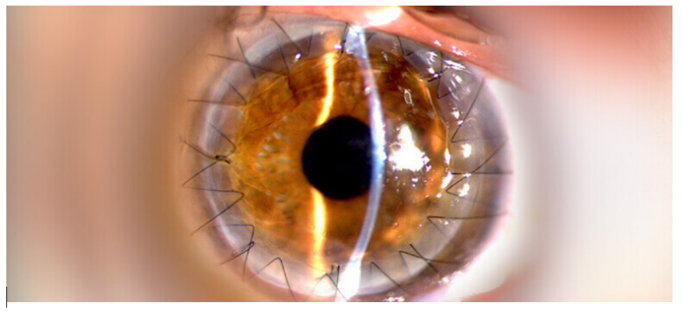 el-trasplante-de-cornea-un-procedimiento-esencial imagen de artículo