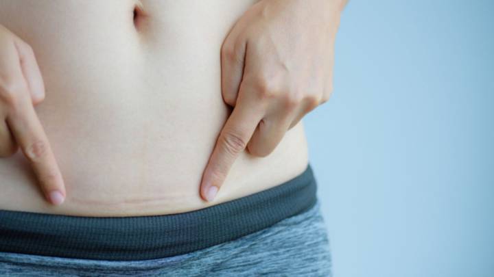 que-es-una-cesarea-cuales-son-las-indicaciones-y-cuidados-posoperatorios imagen de artículo