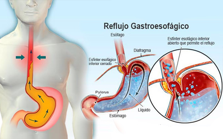 Lo que debes saber sobre el Reflujo Gastroesofágico