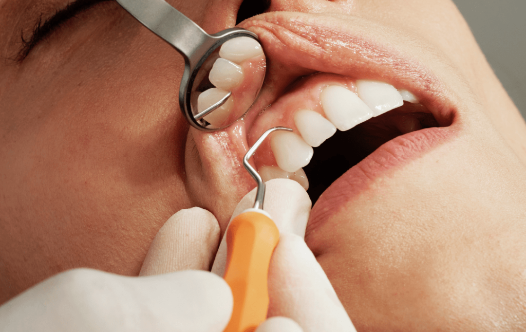 caries-por-ortodoncia-como-prevenirlas imagen de artículo