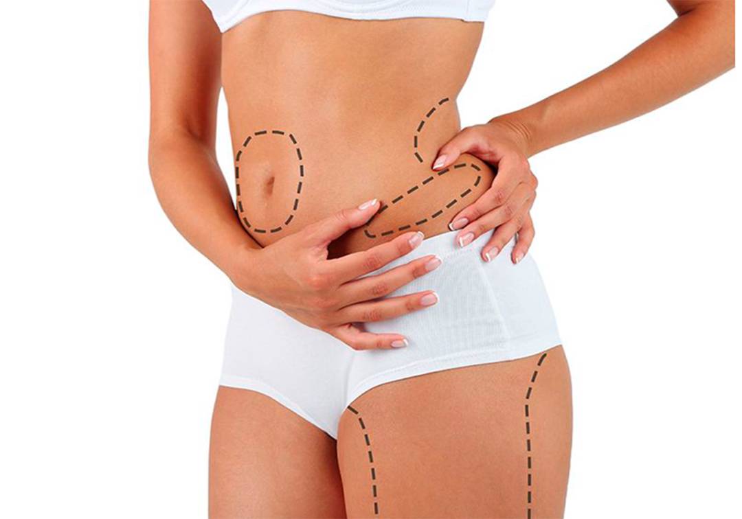 lipoaspiracion-circunferencial-opcion-para-tratar-zonas-mas-complejas imagen de artículo