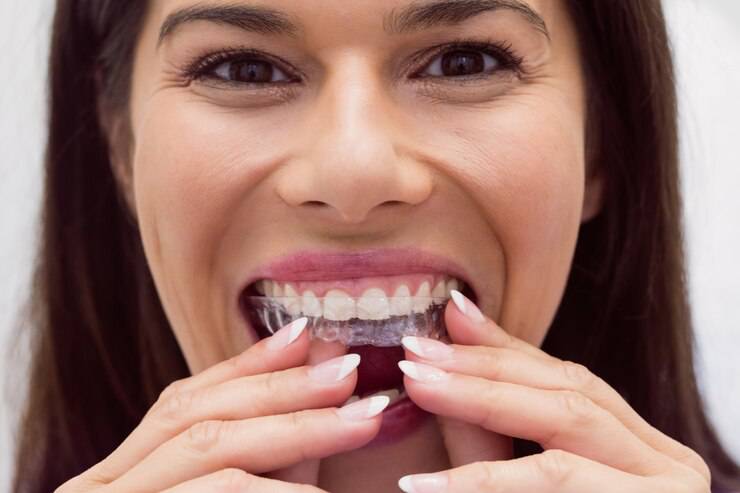 Invisalign: Tratamiento novedoso para mejorar tu sonrisa