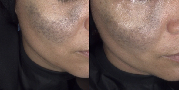 nevus-de-otay-hemangioma-marca-de-por-vida-o-tiene-tratamiento imagen de artículo