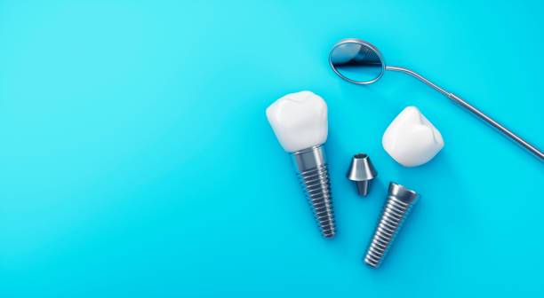 Implantes Dentales: una solución bucal duradera