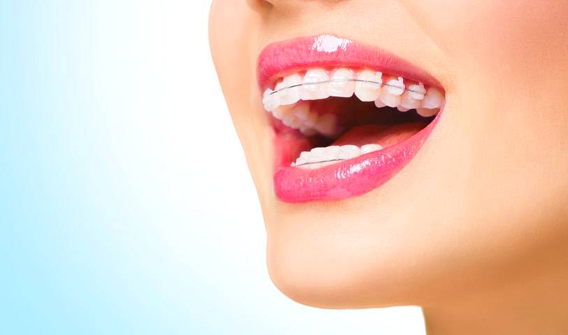 ¿Qué tipos de Ortodoncia Estética existen?