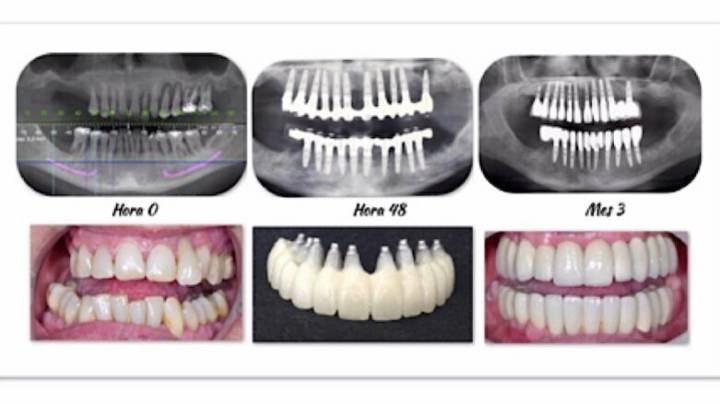 implantologia-biodinamica-un-enfoque-innovador-para-la-restauracion-de-arcos-completos imagen de artículo