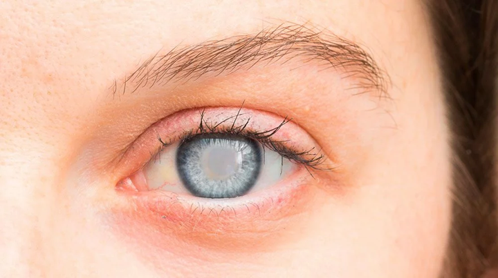 glaucoma-la-enfermedad-silenciosa-que-debes-conocer imagen de artículo