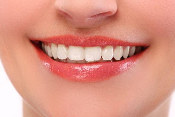 Lentes Cerámicos de Alta Estética (Veneers): La solución para una sonrisa radiante