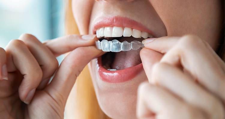 Conoce lo que es el Invisalign: una manera de obtener dientes lindos 