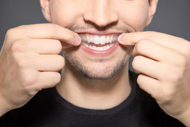 Blanqueamiento Dental: ¿Cómo se lleva a cabo?