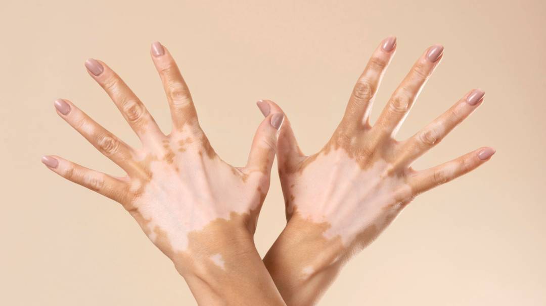 vitiligo-tratamientos-dermatologicos-efectivos-para-mejorar-piel imagen de artículo