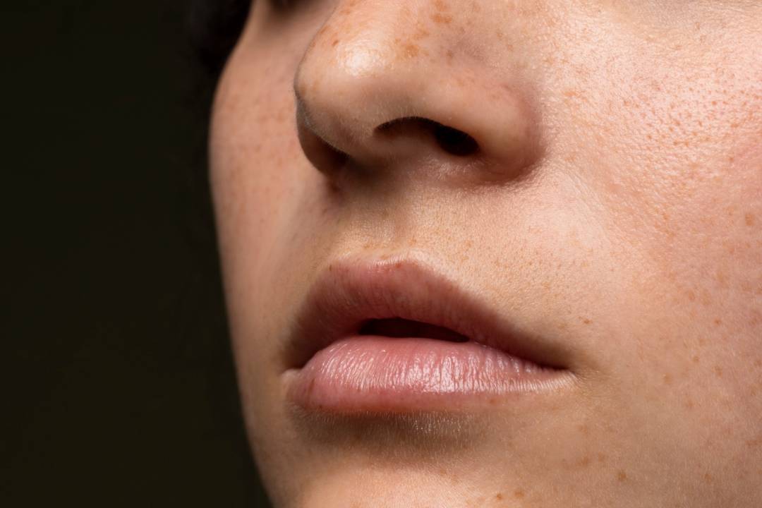 melasma-por-que-salen-como-eliminar-manchas-oscuras-piel imagen de artículo