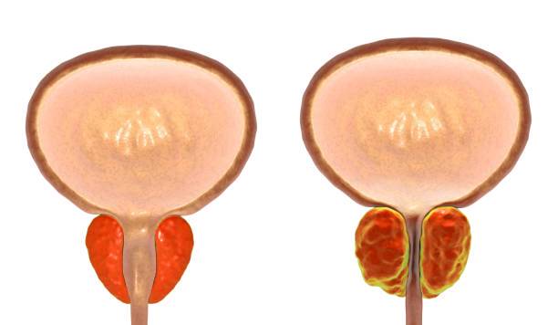 cirugia-laser-en-hiperplasia-prostatica-avances-y-beneficios imagen de artículo