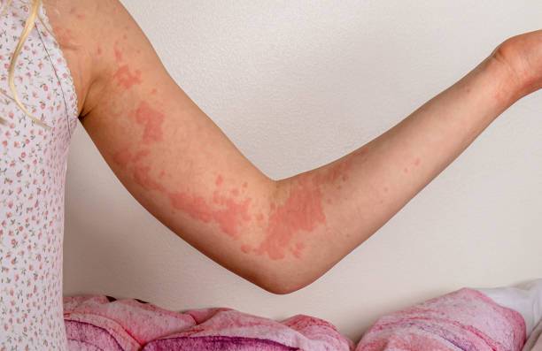 urticaria-en-la-infancia imagen de artículo