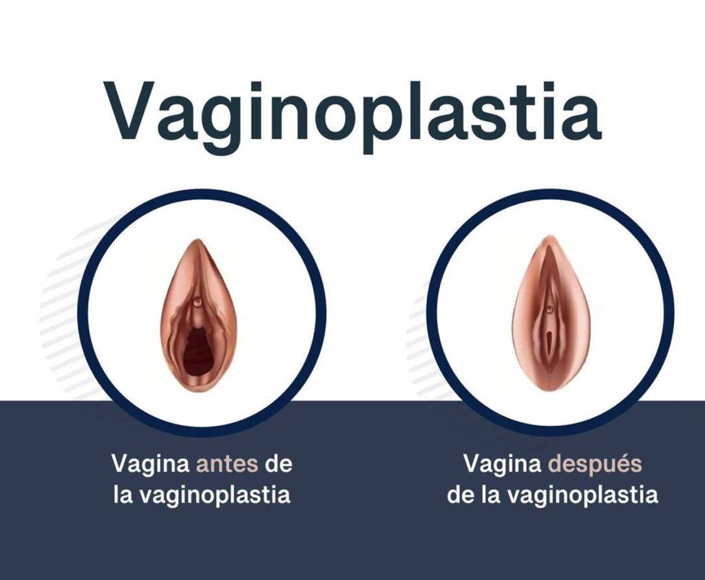 Vaginoplastía Láser: Una solución moderna para mejorar la función y estética vaginal