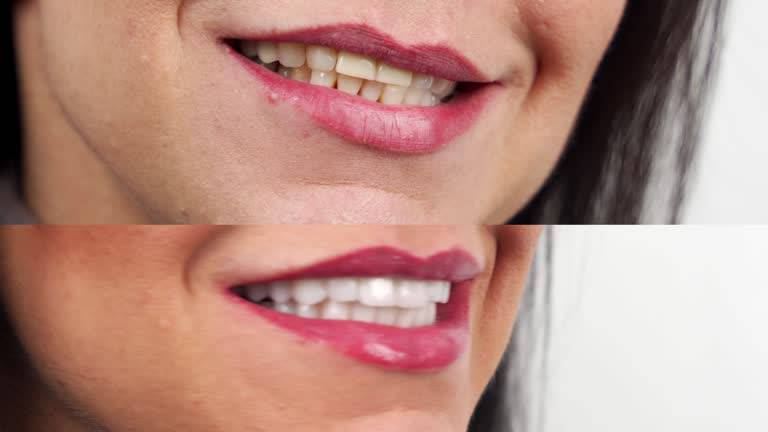 Blanqueamiento Dental: Un procedimiento clave para una sonrisa rejuvenecida