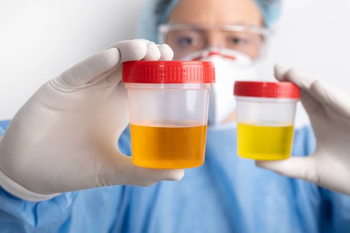 hematuria-importancia-diagnostico-temprano-prevenir-complicaciones imagen de artículo