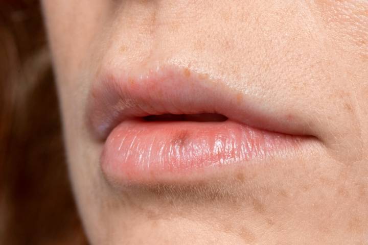cancer-labio-causas-primeros-sintomas-medidas-prevencion imagen de artículo