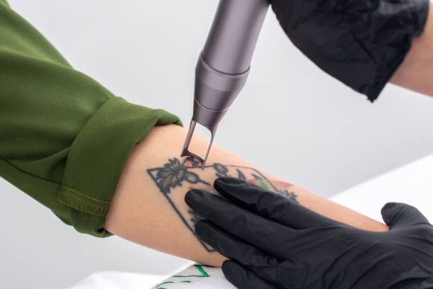 despidete-de-tu-tatuaje-descubre-la-eliminacion-laser imagen de artículo