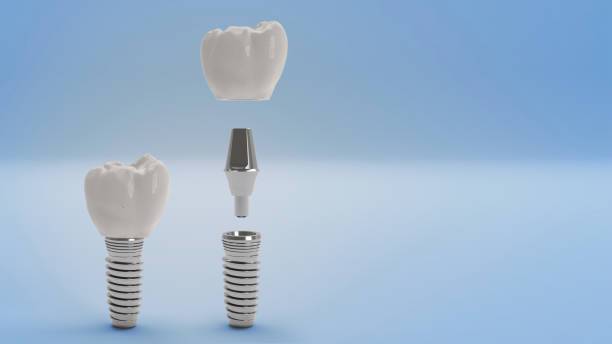 implantes-dentales-la-solucion-definitiva-para-tu-sonrisa imagen de artículo