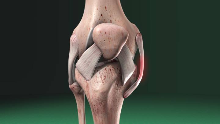 cuida-tus-rodillas-tratamiento-de-lesiones-de-ligamentos-y-meniscos imagen de artículo