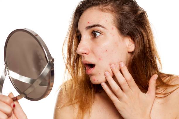 acne-como-combatir-este-padecimiento imagen de artículo