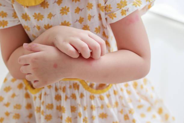 el-impacto-de-las-alergias-en-el-desarrollo-infantil imagen de artículo