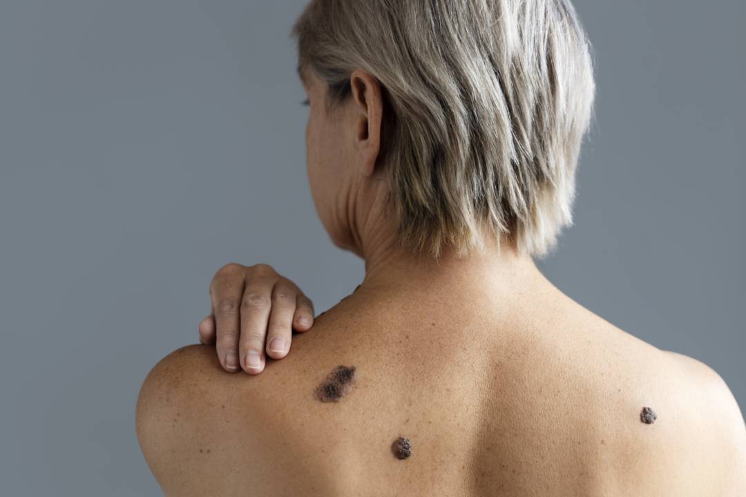 prevencion-y-tratamiento-del-melanoma-protege-tu-piel-y-tu-salud imagen de artículo