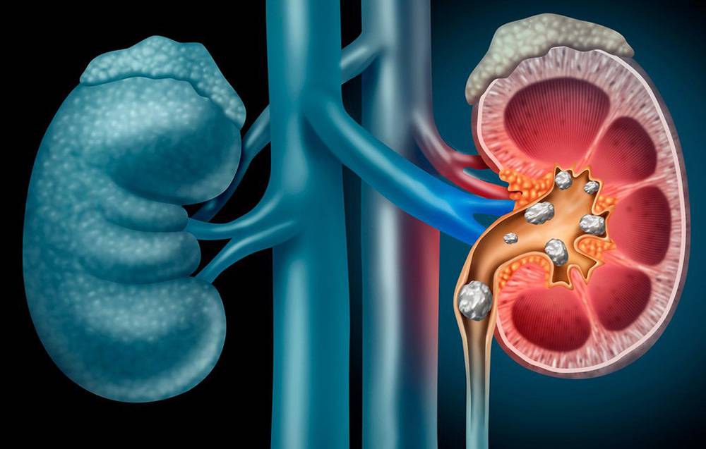 calculos-renales-como-controlar-dolor-prevenir-complicaciones imagen de artículo