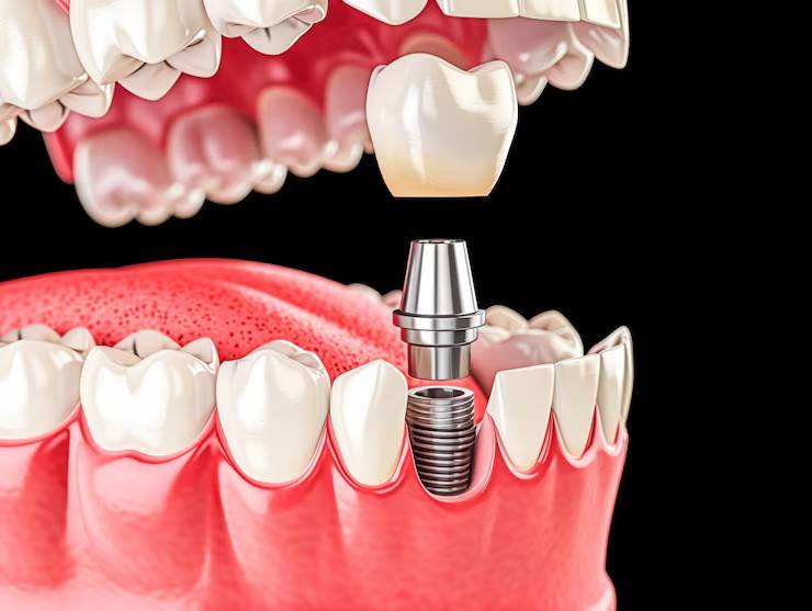 implantologia-corticobasal-solucion-innovadora-perdida-dientes imagen de artículo