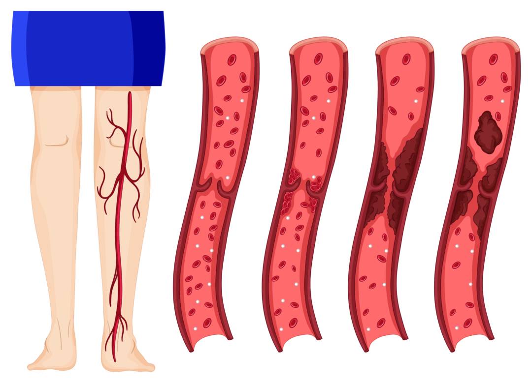 flebologia-cuidado-integral-salud-venas imagen de artículo