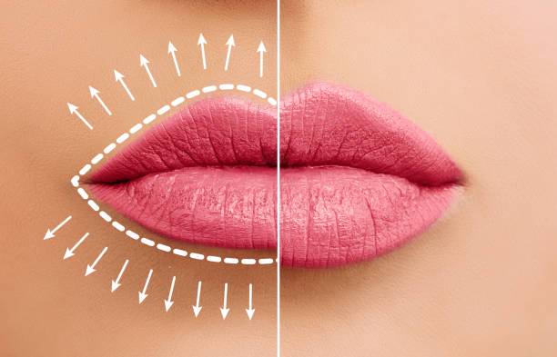 aumento-de-labios-la-tendencia-que-esta-revolucionando-la-estetica-facial imagen de artículo