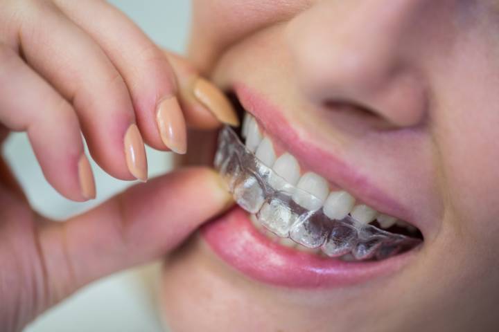 brackets-de-autoligado-vs-alineadores-cual-es-la-mejor-opcion-para-ti imagen de artículo