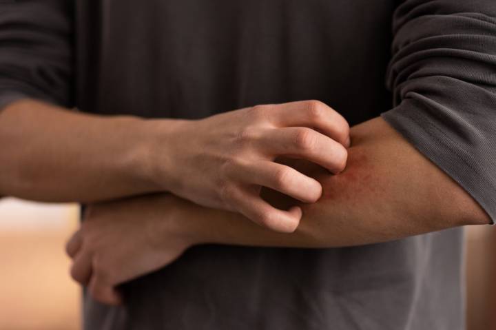 dermatitis-estres-factores-riesgo-sintomas-opciones-tratamiento imagen de artículo