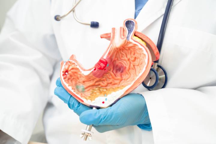 cancer-gastrico-causas-prevencion-enfoque-integral-diagnostico-temprano imagen de artículo