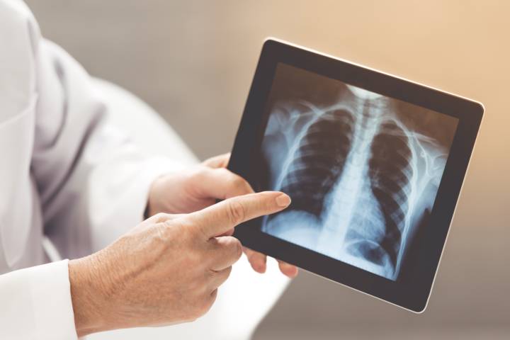 cancer-pulmon-factores-riesgo-diagnostico-avances-tratamiento imagen de artículo