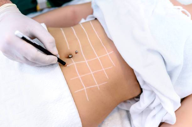 liposuccion-abdominoplastia-lipotransferencia-cual-elegir imagen de artículo